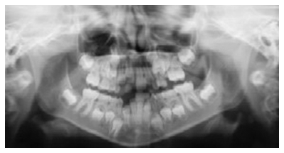 Children Teeth X-ray